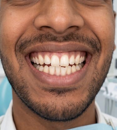 Before: Aligners