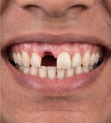 Before: Dental implants