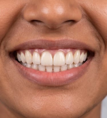 After: Digital Smile Design