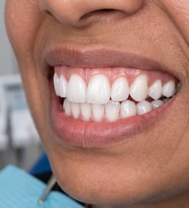 After: Teeth whitening